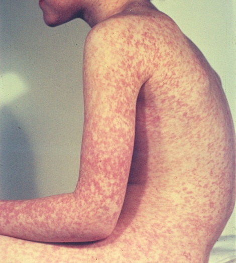 measles-boy-sideview_lrg
